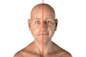 Facial palsy